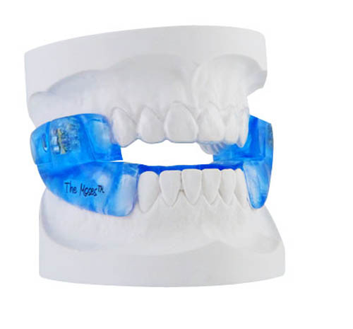 The image displays a set of dental implants with blue staining, showcasing the appearance of an upper denture against a white background.
